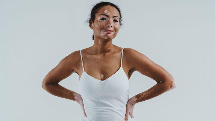How vitiligo affects your mental health